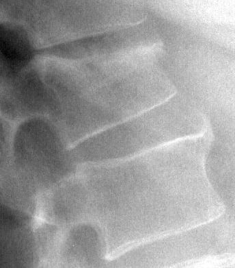 Vertebral Wedge Osteoporotic Fracture Vertebral fractures can be gradual and asymptomatic Diagnosis confounded by