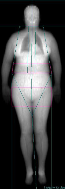 Android/Gynoid Android/Gynoid ROIs Android to Gynoid ratio (waist to hip fat ratio) A measure of obesity which may be closely related to metabolic disturbances and cardiovascular diseases