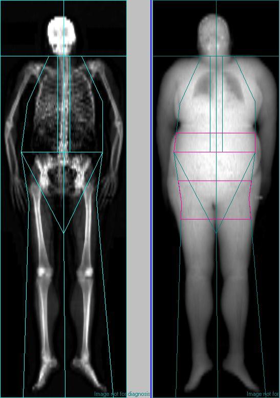 Limitations of DXA Total Body Scan Physical dimensions of scan table can make it hard to scan tall (>195cm) or wide subjects Weight limitation of scan table