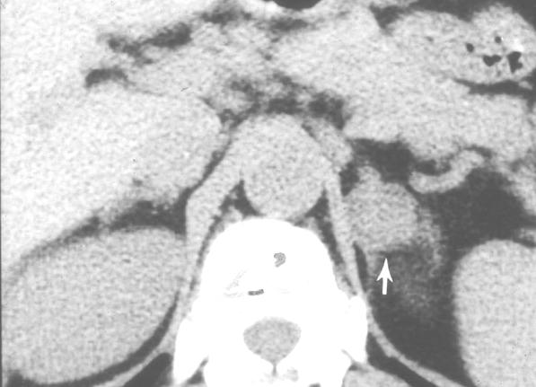 University of Michigan adrenal mass characterisation protocol using CT If an adrenal mass is seen on a contrast-enhanced staging CT, we bring the patient back for a dedicated adrenal CT.