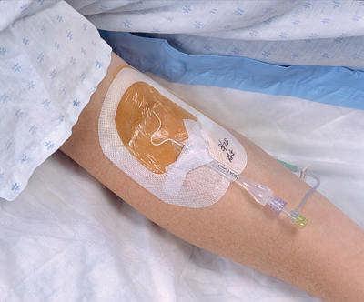 Peripherally Inserted Central Catheter Percutaneous, single or multi-lumen line inserted in the arm.