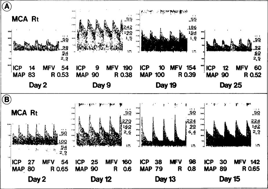 Doppler evaluation of vasospasm at different ICP's FIG. 2.
