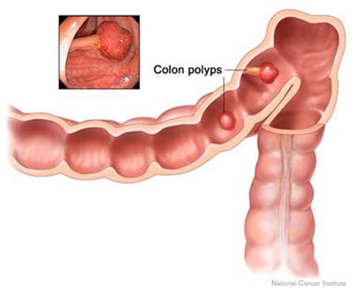 Risk factors polyps A polyp is a growth of tissue in the lining of an organ.