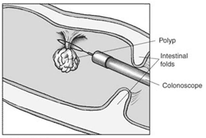 Colonoscopy If polyps are found during a colonoscopy they can be removed with tools used through the