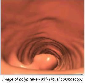 CT colonography Air is pumped into the colon through a flexible tube CT scans are then done Special computer programs create both 2-dimensional
