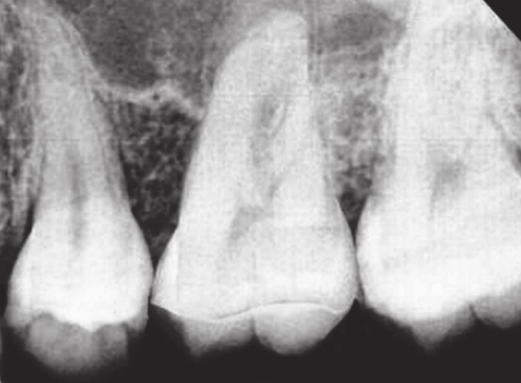 opposing tooth into the edentulous area. Pre prosthetic preparation is often required before a fixed prosthesis can be planned; this may even require planned tooth movement.
