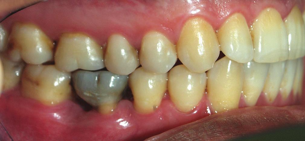 CASE REPORT Mostfvi nd Flhchi: Rehilittion of mndiulr root mputted molr A 35 yer old mle ptient ws referred to the Prosthodontics Deprtment of Tehrn University of Medicl Sciences with mndiulr right
