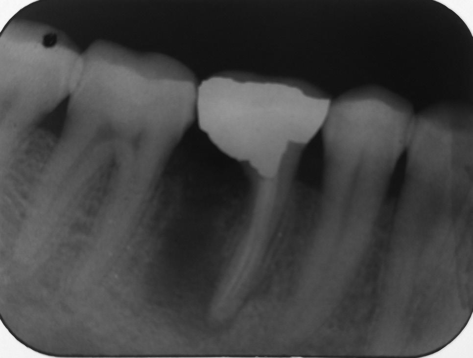 Root cnl therpy nd n extensive deficient mlgm restortion hd een done for the tooth. After consulttion with the endodontic deprtment, the ccurcy of existing endodontic tretment ws verified.