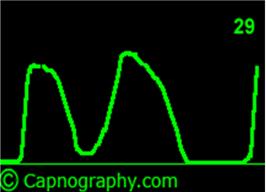 Why Waveform Capnography and Why During and Post CPR?