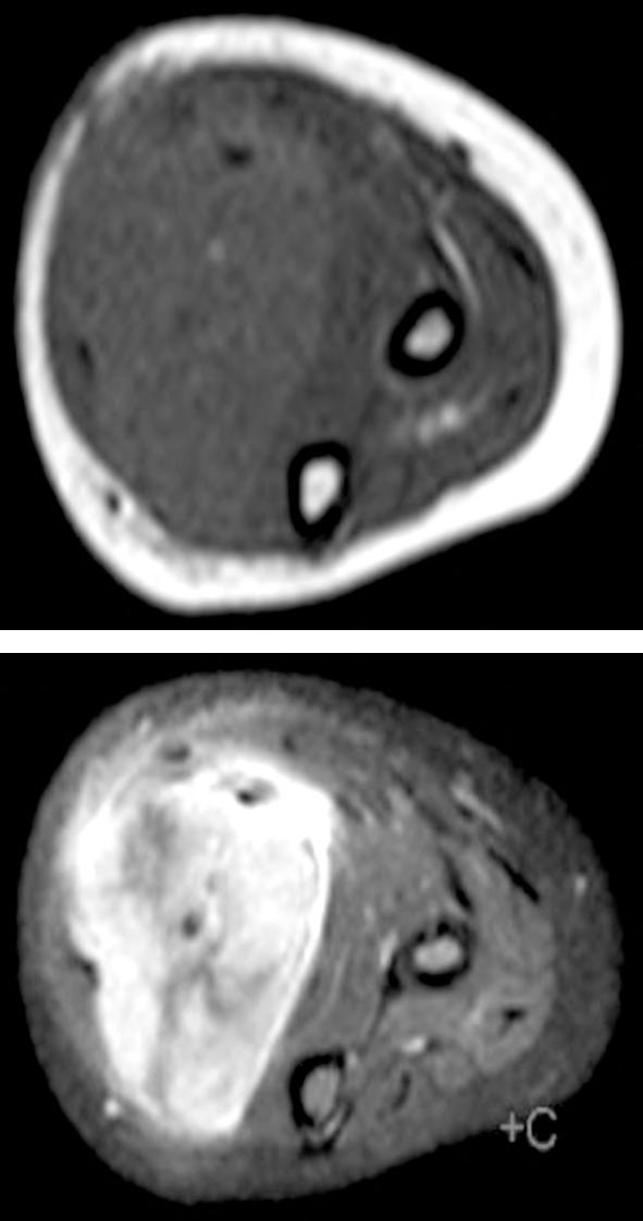 8 X 10 3 mm 2 /s (e). (C) (A) (B) (C) (D) Fig. (2): 15 years old female with recurrent synovial sarcoma.
