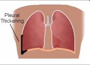 During this process the pleura becomes inflamed and creates fibrosis (scarring) which hardens and thickens the once saran wrap thin, stretchy pleura.