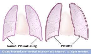 Pleuritis Inflamed pleural layers (pleuritis) can rub against each-other when the lungs expand to breath air in.