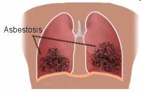 Interstitial Asbestos Related Disease (Asbestosis) The term asbestosis has historically only been used in reference to scarring of the