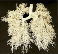 This is why people with pleural asbestos related disease (ARD) are not described as having asbestosis.