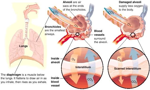 This inflammation can lead to scarring in the intersitium, eventually making it difficult for the alveoli (air sacs) to supply oxygen