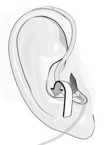 B C Never insert the speaker in the ear canal without the dome attached. Do not force the speaker too deeply into your ear canal.