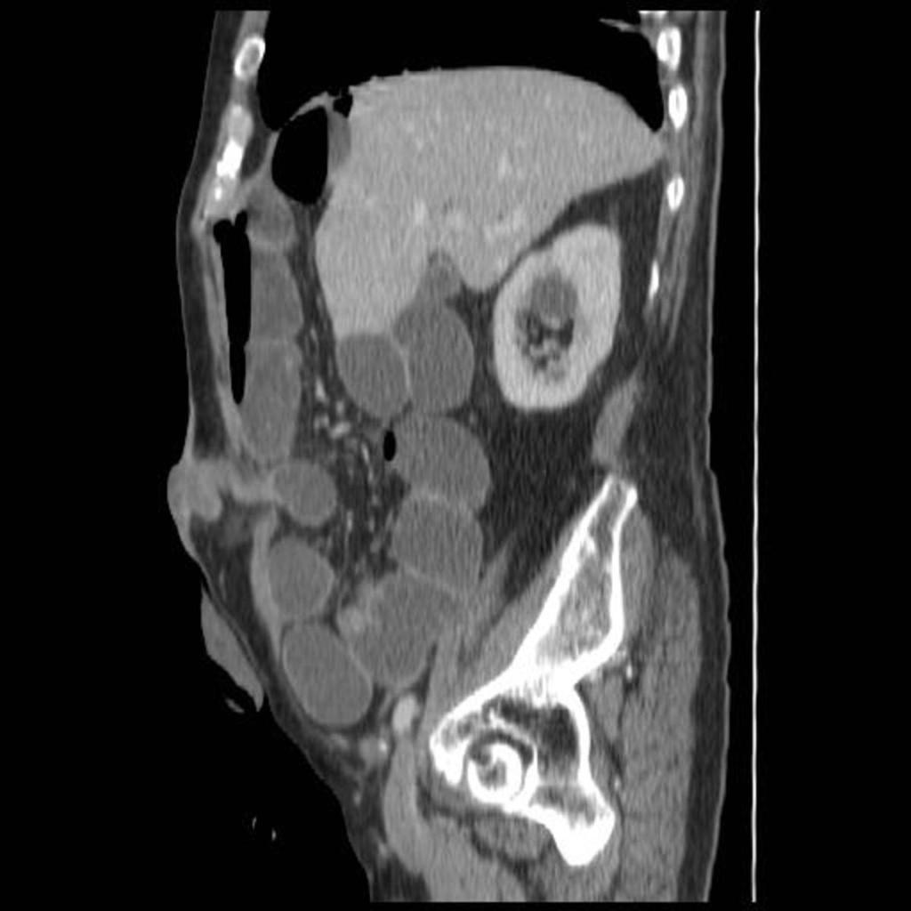 Fig. 4: Saggital CT section in the same patient demonstrating high-grade