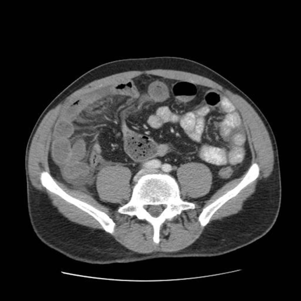 Fig. 5: Axial CT images in a patient with Closed-loop obstruction demonstrate small bowel obstruction due to adhesion just to the right of midline.