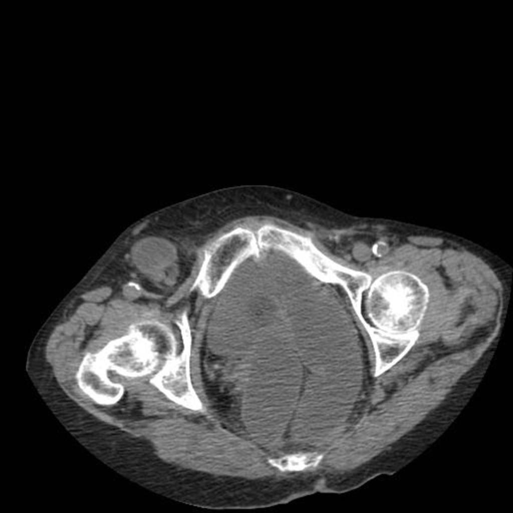 Fig. 8: Axial and Saggital CT images in a patient with high-grade