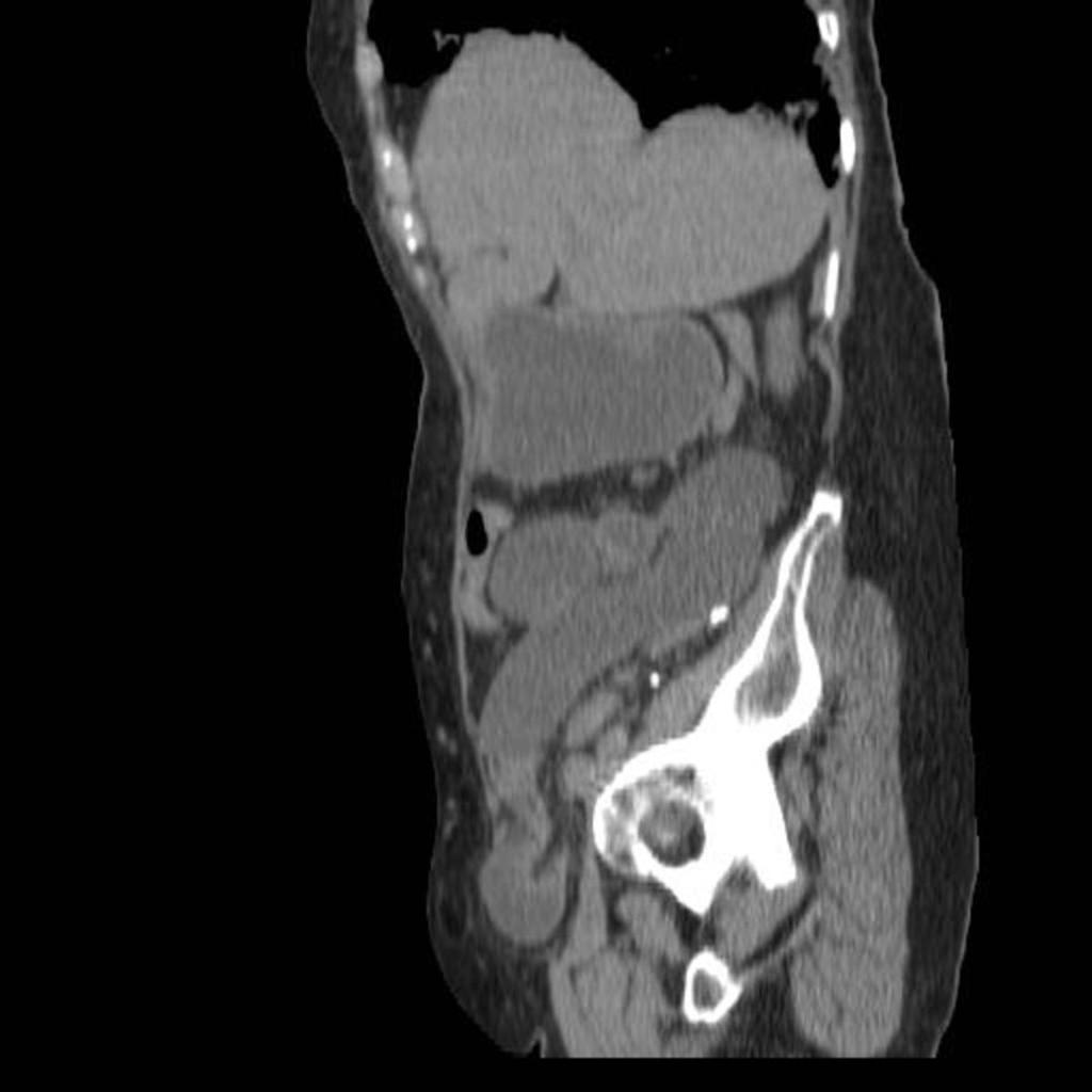 Fig. 9: Axial and Saggital CT images in a patient with high-grade