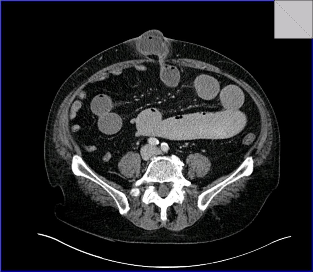 Fig. 10: Axial CT section demonstrating an
