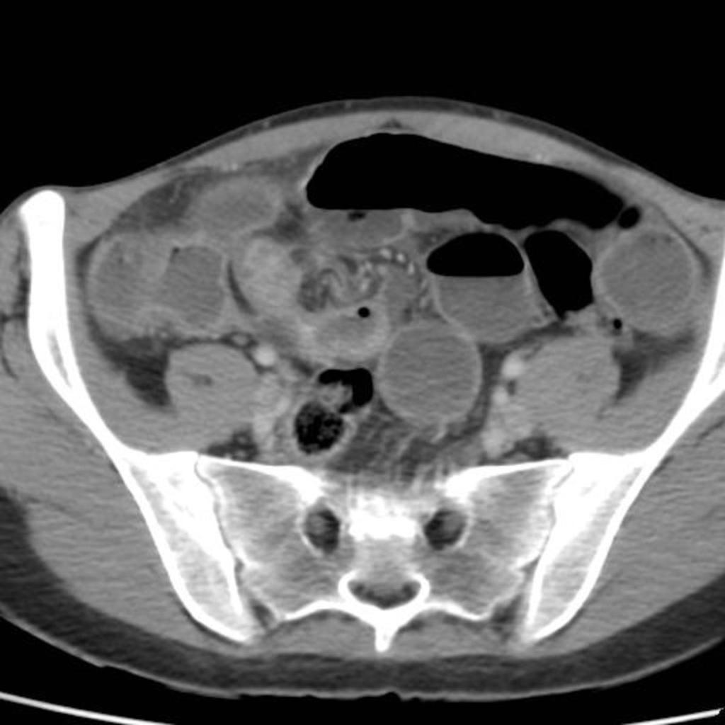 Fig. 12: Axial CT section demonstrates mural thickening and enhancement in terminal ileum in a patient high grade small bowel