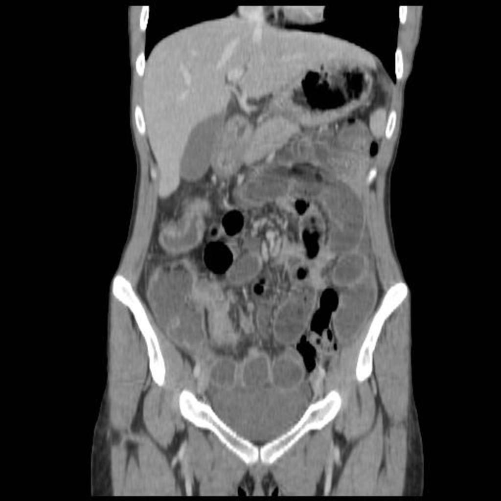 Fig. 13: Coronal CT section demonstrating high grade small bowel