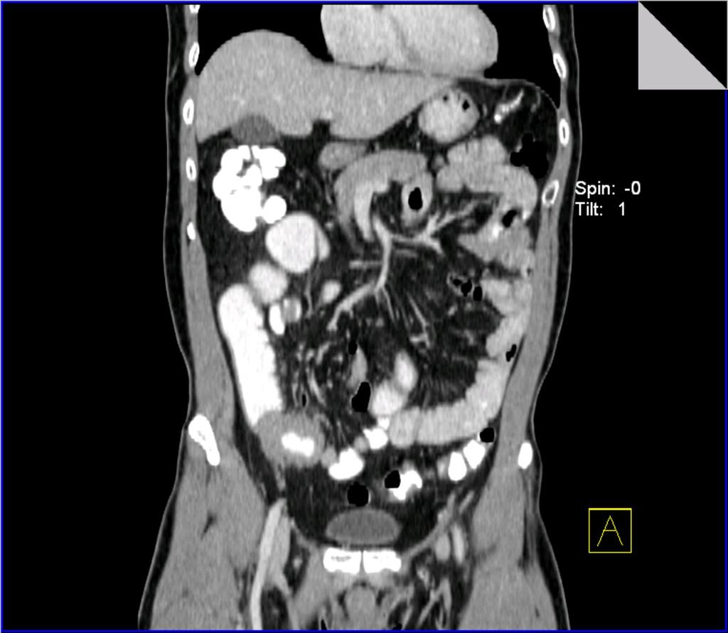 Fig. 14: Coronal CT section demonstrates significant segmental mural