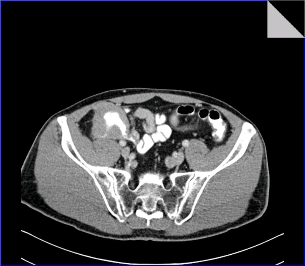 Fig. 15: Axial CT section in the same patient with