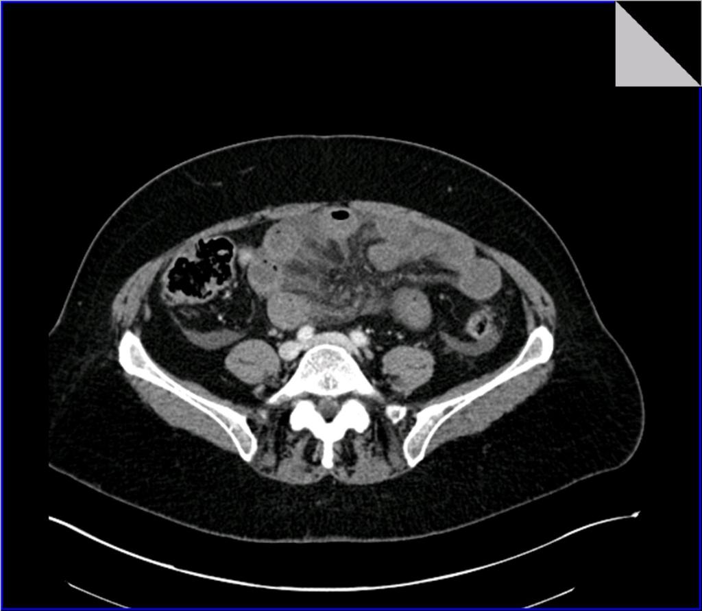 Fig. 16: Axial CT section demonstrates small bowel