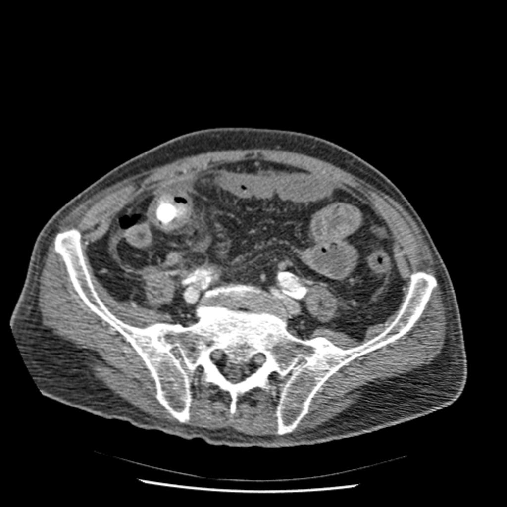 Fig. 17: Axial CT section demonstrates an obstructing