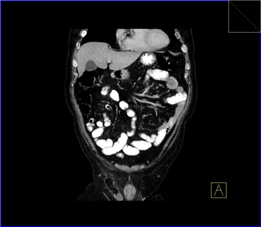Fig. 18: Coronal CT section demonstrates a jejuno-jejunal