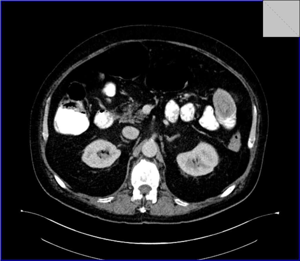 Fig. 19: Axial CT section in the same patient
