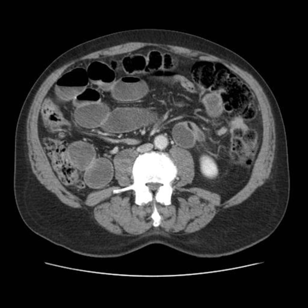 Fig. 1: Axial CT image demonstrates sudden change in the caliber of small bowel loop just to the