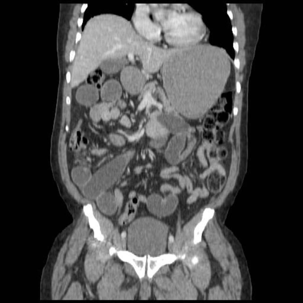 Fig. 2: Coronal CT image in the same patient demonstrates the point of small bowel obstruction to