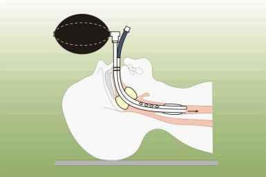 Insertion Technique Auscultate over the epigastrum, if gurgling is heard then remove the tube.