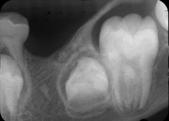 whether it is odontogenic or non-odontogenic. effects on adjacent structures this ameloblastic fibro-odontome arising coronal to the teeth is of odontogenic origin.