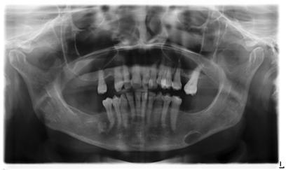 endodontic treatment.