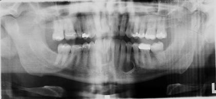 the STAFNE defect, or latent bone cavity, is an invagination of