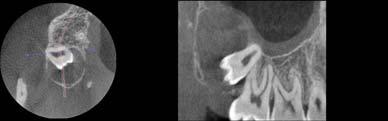 canal. radiographically, an incisive foramen with a horizontal diameter >10 mm.