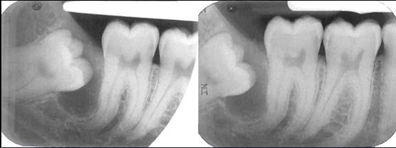 dentigerous cysts are well-defined, variablycorticated, hydraulic, radiopaque entities