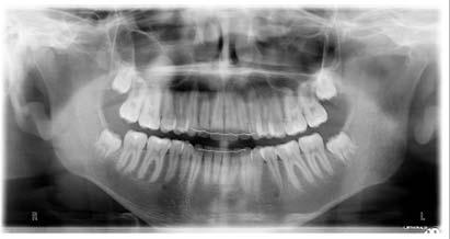 RADIOPAQUE metal (restorations, sutures, bullet fragments) radiopaque white restorations and cements enamel dentin cementum cortical
