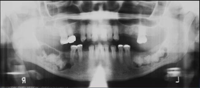 dense bone island an asymptomatic, non-inflammatory hamartoma that may or may not have an apparent association with teeth. if there is an association, the tooth pulp is vital.