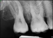 result of pulpal necrosis, periodontal disease,