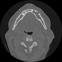the prototypical odontogenic tumour, ameloblastoma is characterized by 3 important radiologic features as identified by WORTH (1963): the presence of septation within a larger cavity.