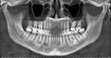 the osseous dysplasias have been known in the past as the cemental