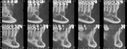 periapical cemental dysplasia) and the cemento-osseous  periapical