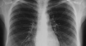 of TB disease CXR, CBC, LFTs normal No known contact with TB