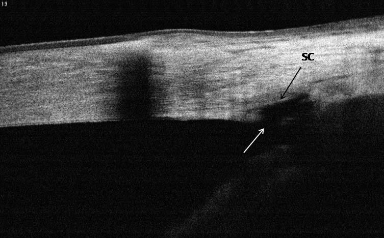 Neovascular Glaucoma with Synechial Angle Closure Scleral vessel Iris vessel Schwalbe s line PAS Courtesy of Brian Francis,
