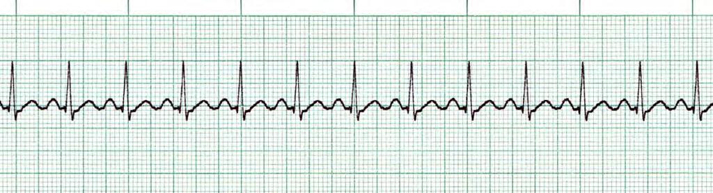 Sinus Tachycardia Sinus Tachycardia represents an increase in the rate of discharge of the sinus node.